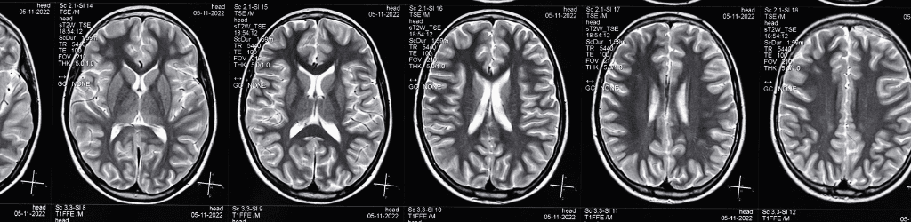 High resolution magnetic resonance image scan of brain